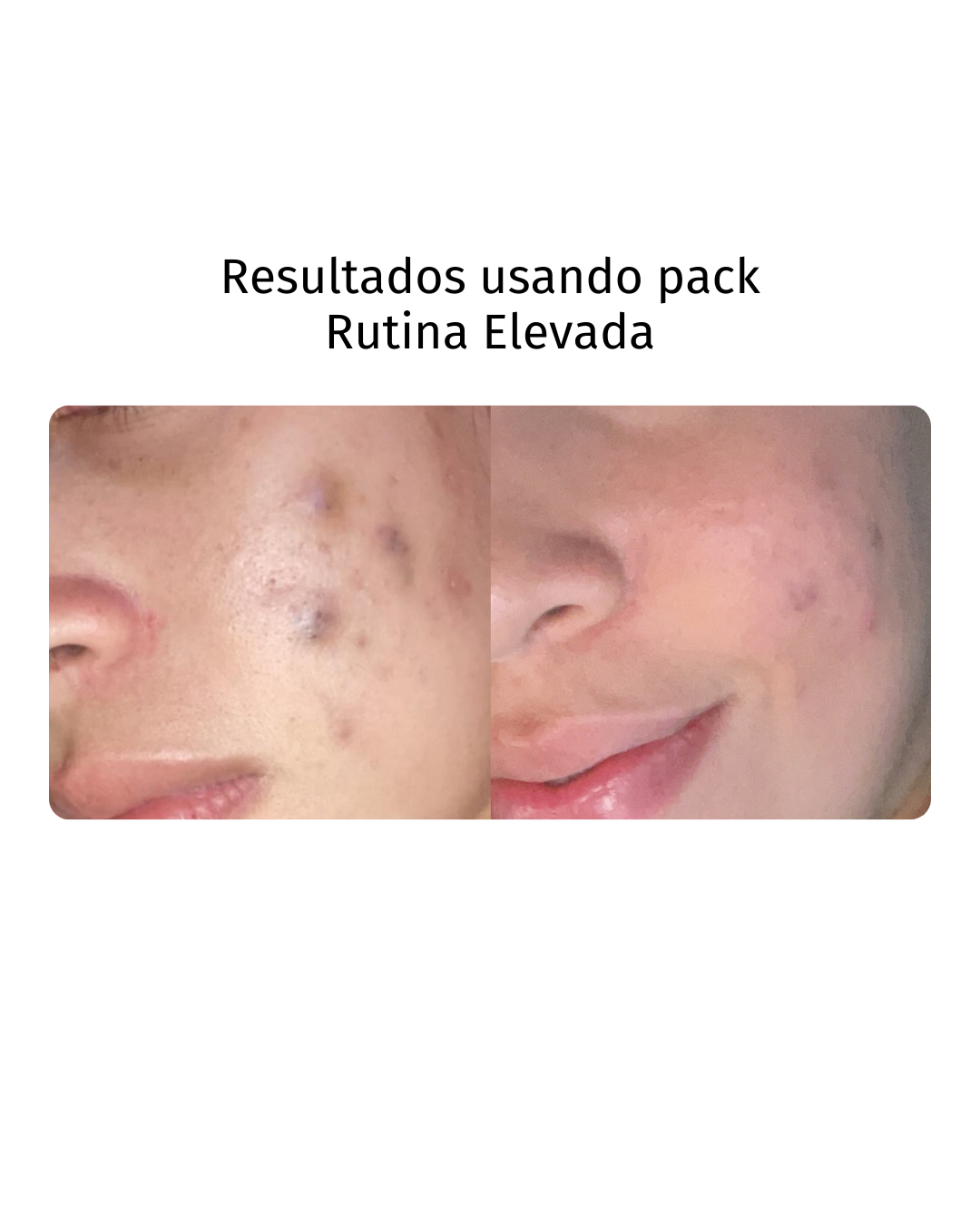 Rutina Elevada: Piel mixta/grasa / Poros / Textura / Acné